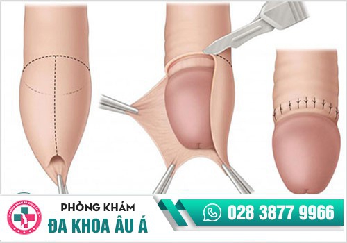 Phẫu thuật cắt bao quy đầu