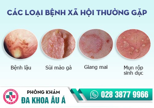 Hình ảnh các bệnh xã hội thường gặp ở nam giới.