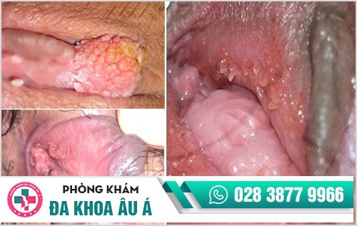 biểu hiện sùi mào gà
