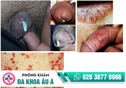 Đau buốt đầu dương vật