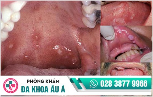 Bệnh sùi mào gà, căn bệnh dễ lây nhiễm nhưng khó điều trị