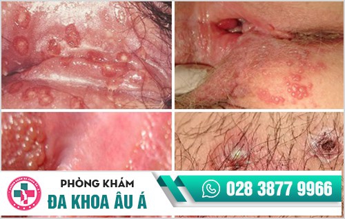 mụn rộp sinh dục nữ