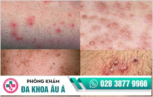 mụn sinh dục