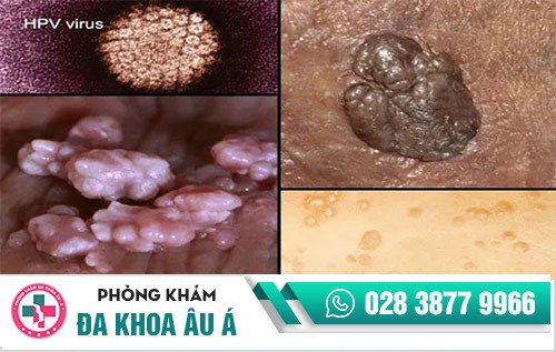 điều trị sùi mào gà ở đâu, trị sùi mào gà ở đâu uy tín, nên điều trị sùi mào gà ở đâu