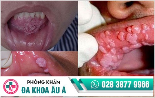 dấu hiệu sùi mào gà ở miệng