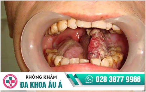dấu hiệu sùi mào gà ở miệng