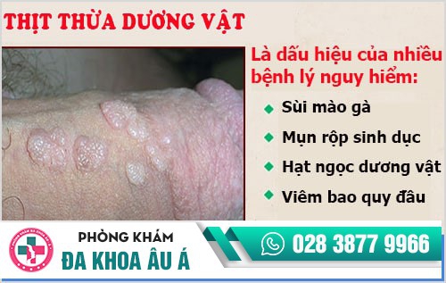 Nam giới cần cảnh giác với thịt thừa dương vật Nam giới cần cảnh giác với thịt thừa dương vật