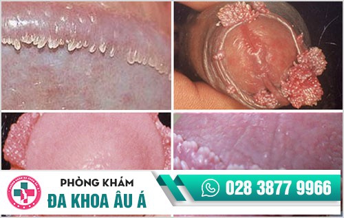Nam giới cần cảnh giác với thịt thừa dương vật Nam giới cần cảnh giác với thịt thừa dương vật