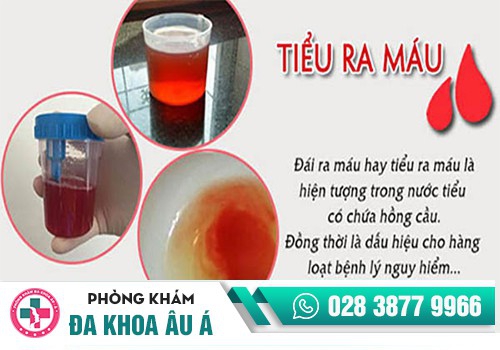 Một số bệnh gây ra hiện tượng nước tiểu màu đỏ