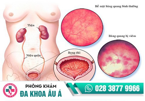 Nguyên nhân gây bệnh viêm bàng quang
