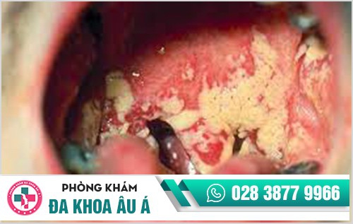 Bệnh lậu ở miệng 