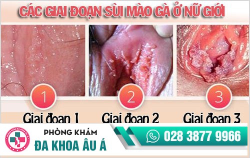 Sùi mào gà