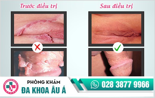 bệnh sùi mào gà