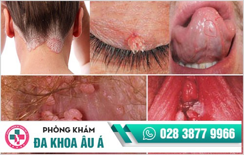 Sùi mào gà nữ