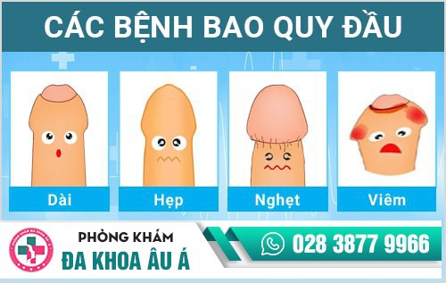 cắt bao quy đầu