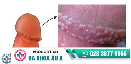 gai sinh dục gai sinh dục