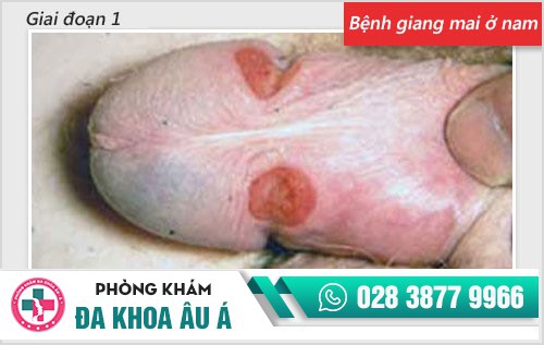 Chi tiết hình ảnh bệnh giang mai ở nam, nữ qua từng giai đoạn