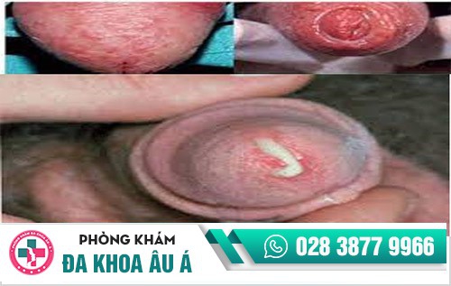 hình ảnh bệnh lậu ở nam giới hình ảnh bệnh lậu ở nam giới