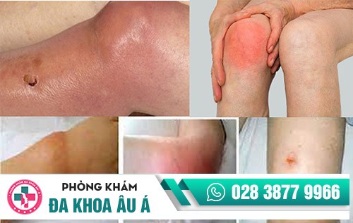 hình ảnh bệnh lậu ở nam giới hình ảnh bệnh lậu ở nam giới