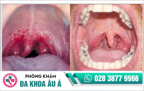 hình ảnh bệnh lậu ở nam giới hình ảnh bệnh lậu ở nam giới