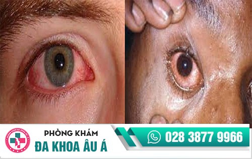 hình ảnh bệnh lậu ở nam giới hình ảnh bệnh lậu ở nam giới