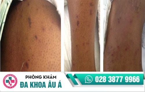hình ảnh bệnh lậu ở nam giới hình ảnh bệnh lậu ở nam giới