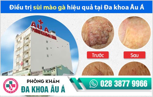 khám bệnh sùi mào gà