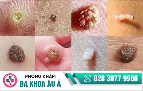 điều trị sùi mào gà ở đâu, trị sùi mào gà ở đâu uy tín, nên điều trị sùi mào gà ở đâu