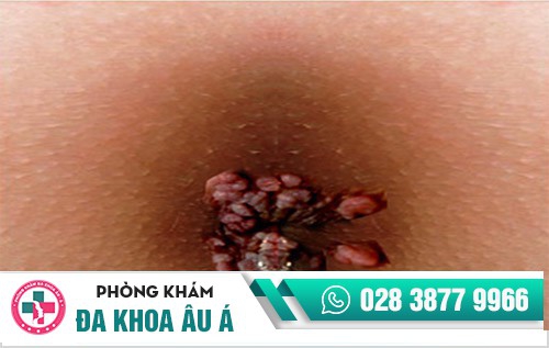 điều trị sùi mào gà ở đâu, trị sùi mào gà ở đâu uy tín, nên điều trị sùi mào gà ở đâu