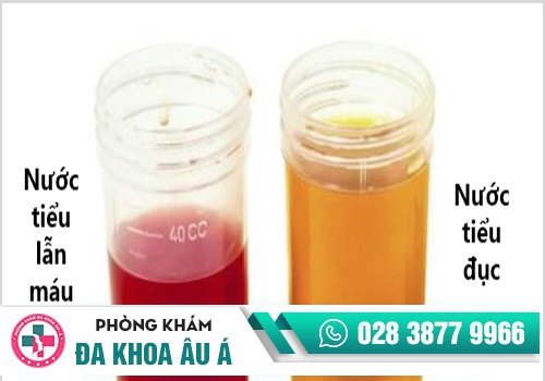 Nước tiểu đục, có lẫn máu là triệu chứng viêm đường tiết niệu ở nam và nữ