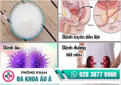 Một số bệnh lý gây ra nước tiểu màu trắng đục
