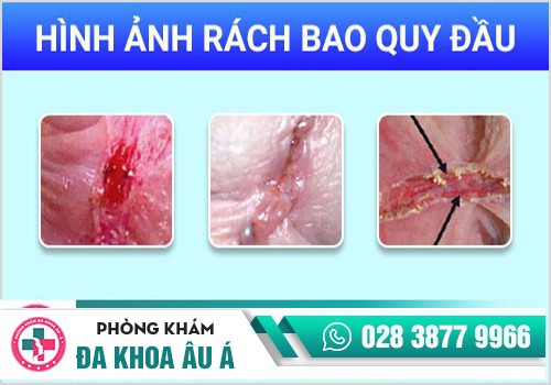 Hình ảnh rách bao quy đầu
