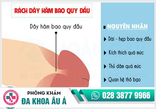 Có nên cắt dây hãm bao quy đầu?