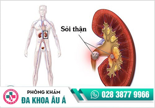 Hình ảnh sỏi thận