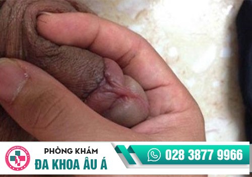 Dương vật bị sưng