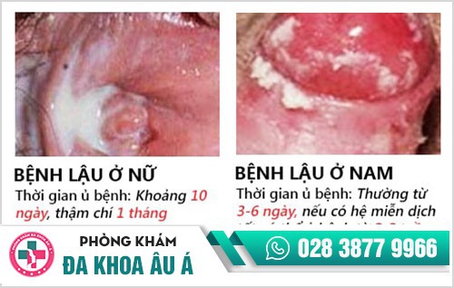 thời gian ủ bệnh lậu thời gian ủ bệnh lậu